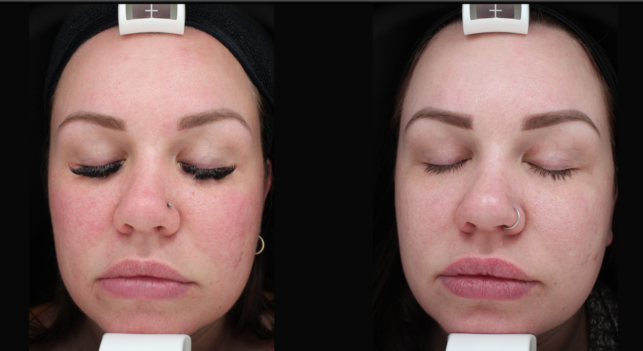 Clinic805-Before-After-IPL-2-1