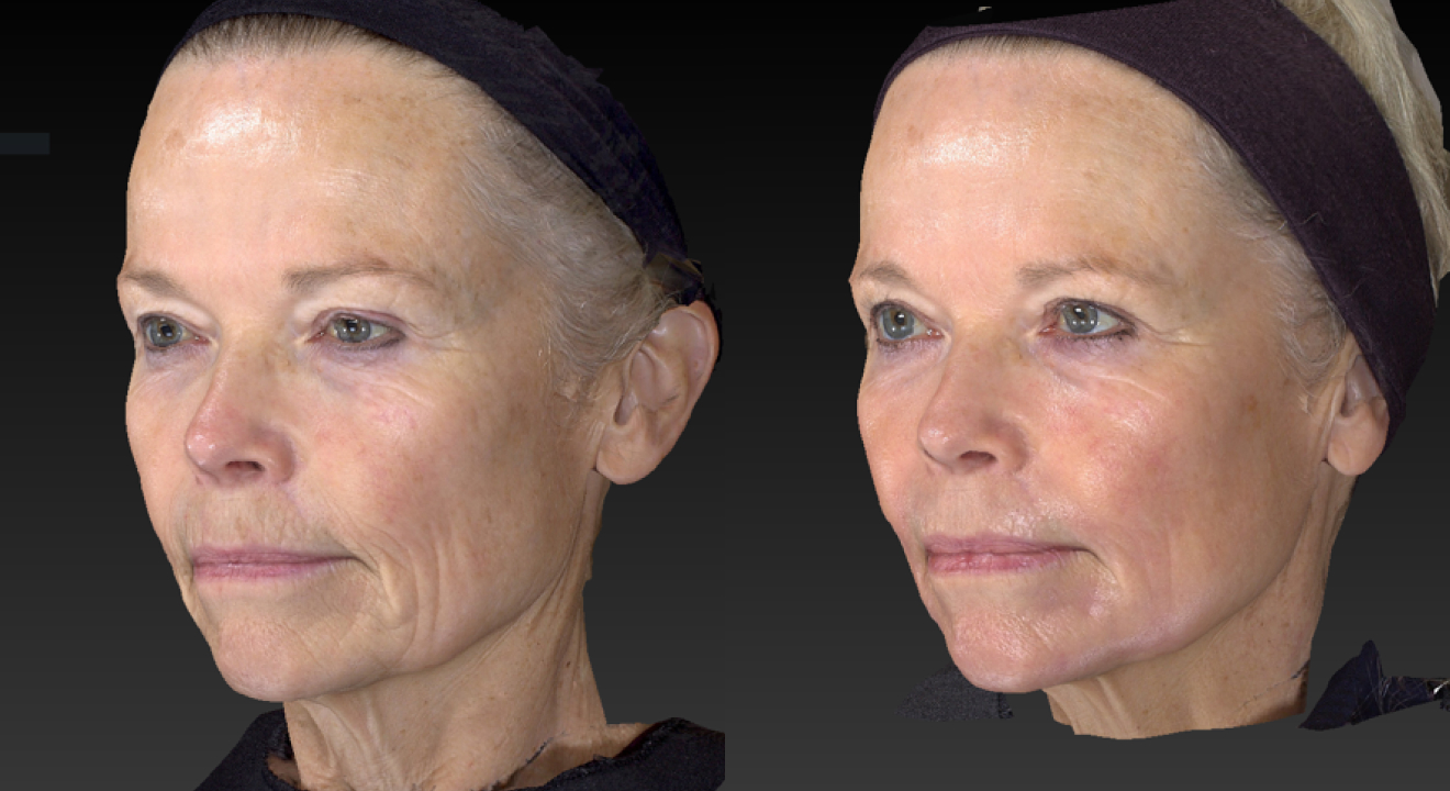 Clinic805-Before-After-Pearl-1-3