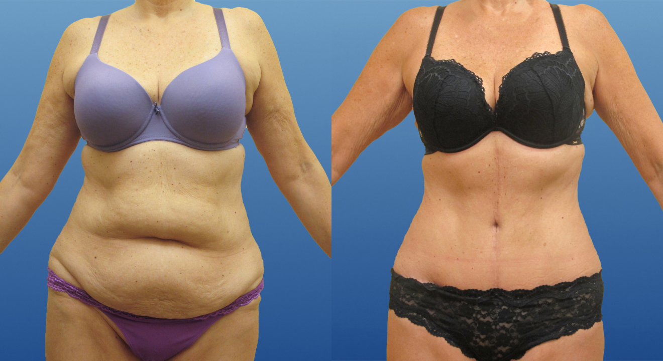 Clinic805-Victoria-Before-After-Abdominoplasty-1-1