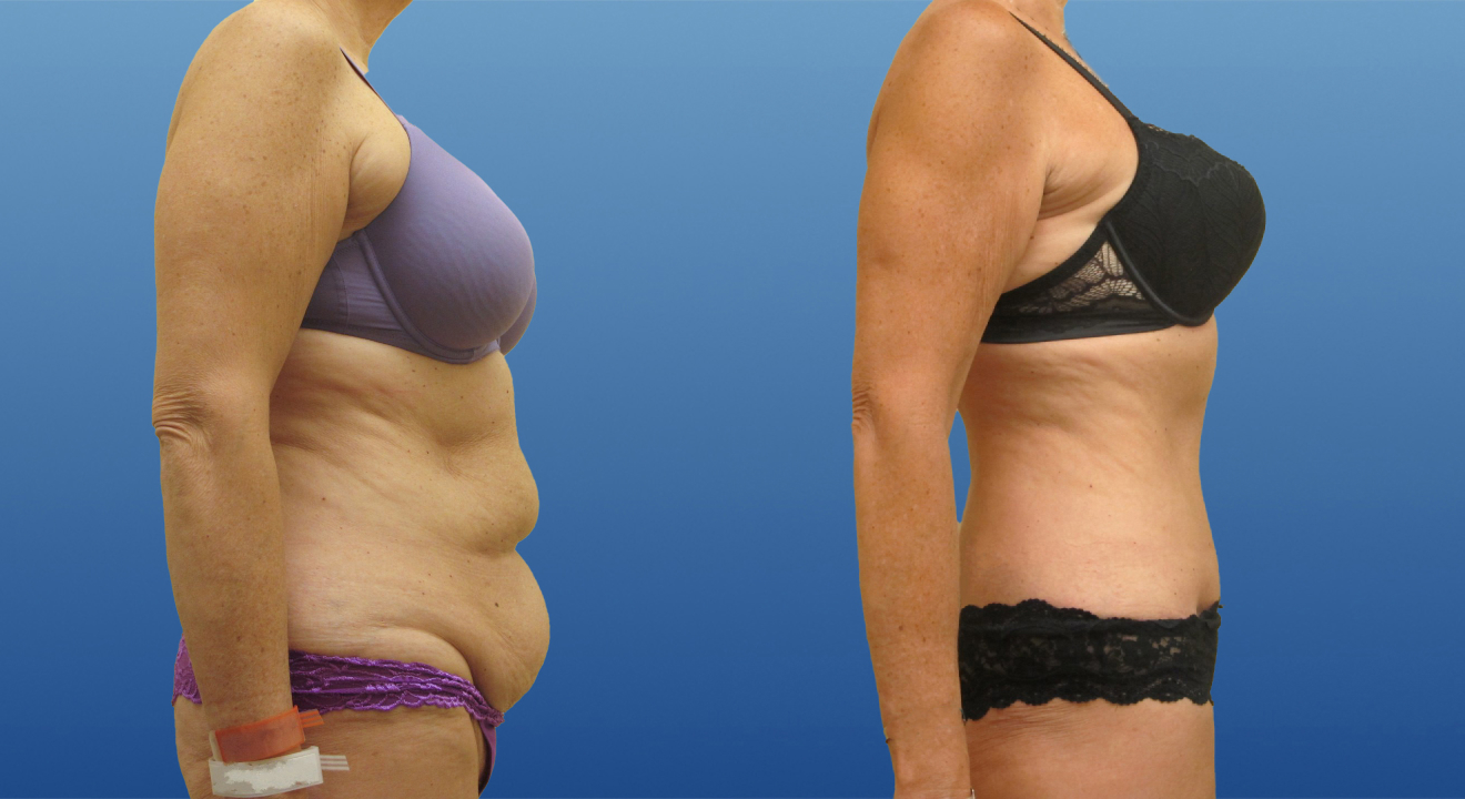Clinic805-Victoria-Before-After-Abdominoplasty-1-2