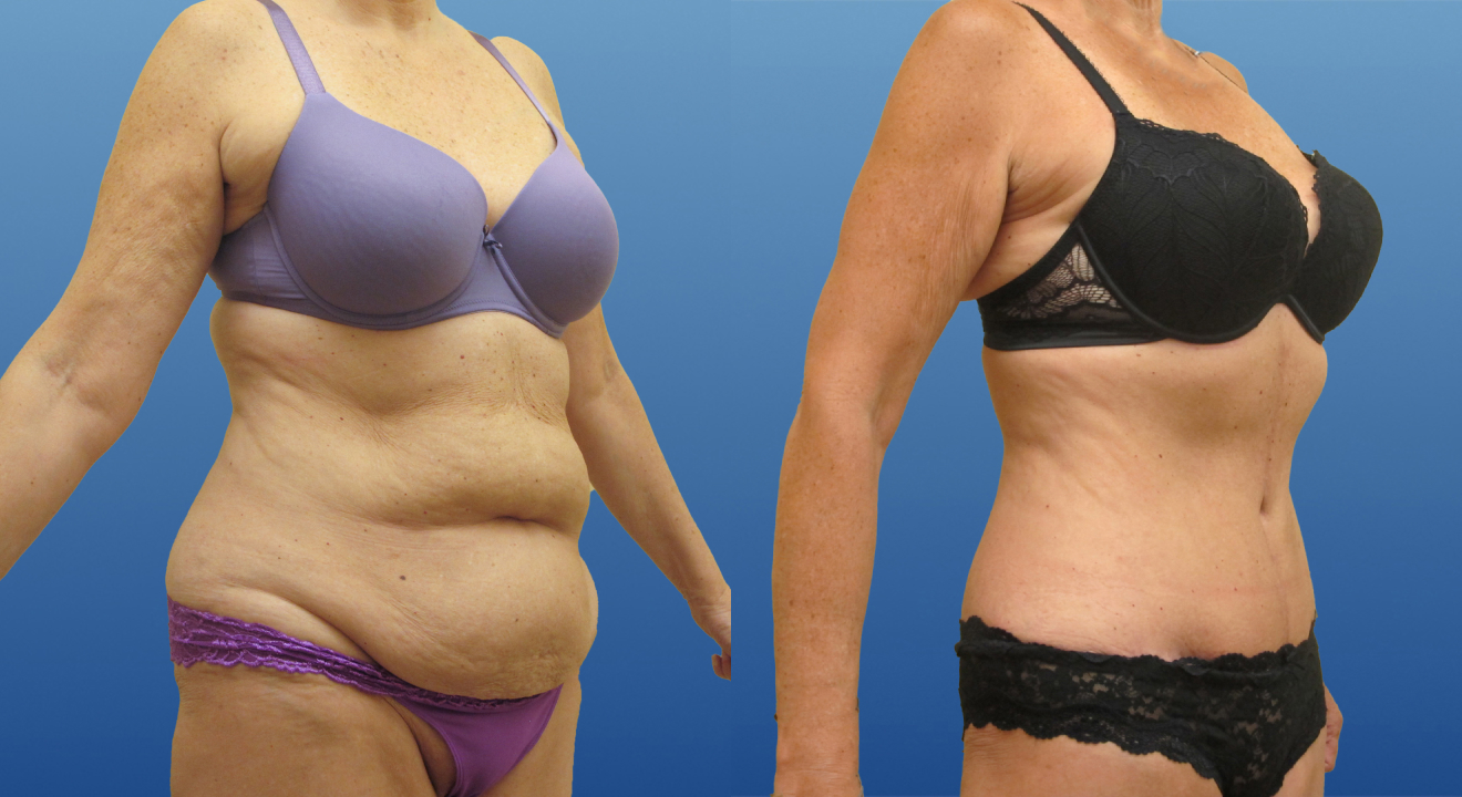 Clinic805-Victoria-Before-After-Abdominoplasty-1-3