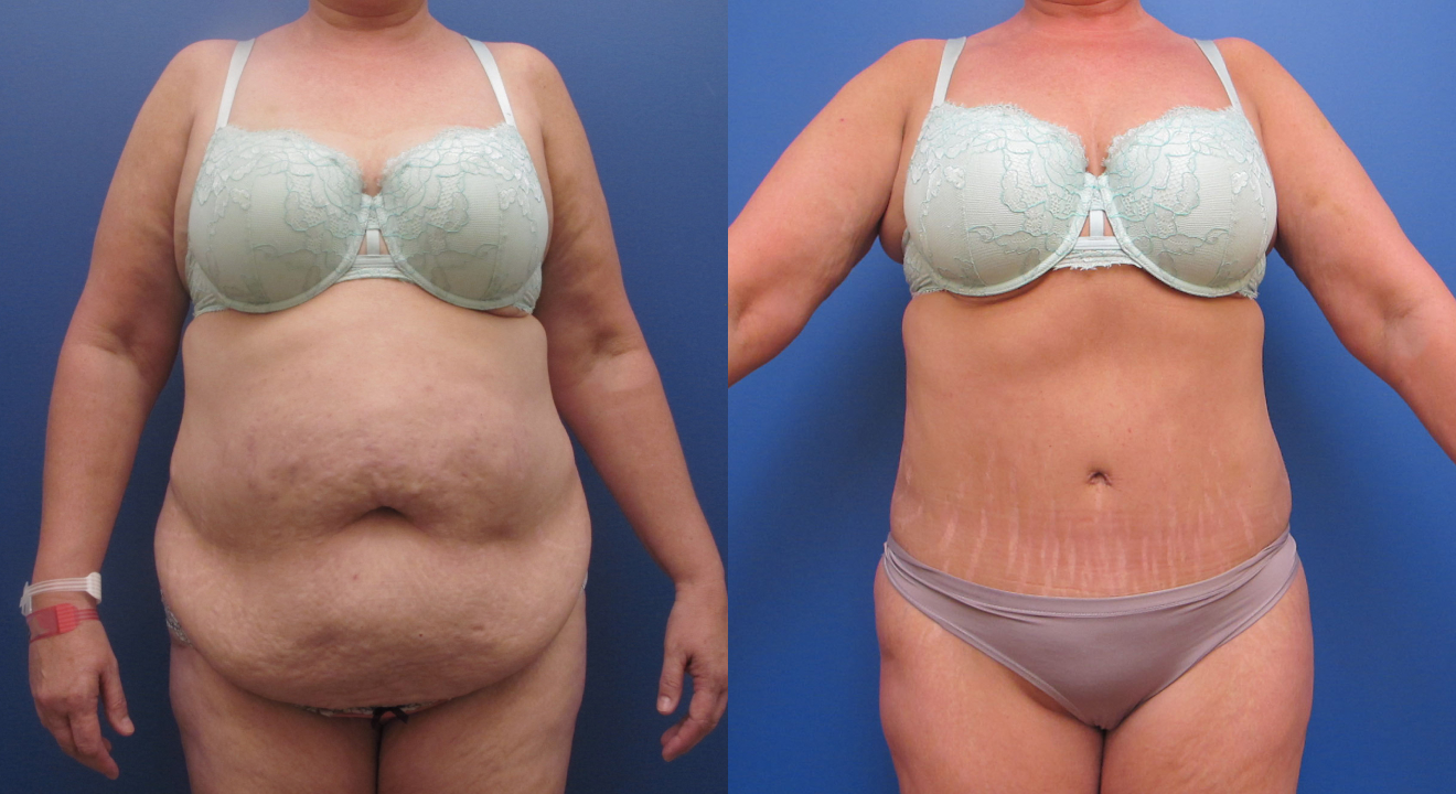 Clinic805-Victoria-Before-After-Abdominoplasty-2-1