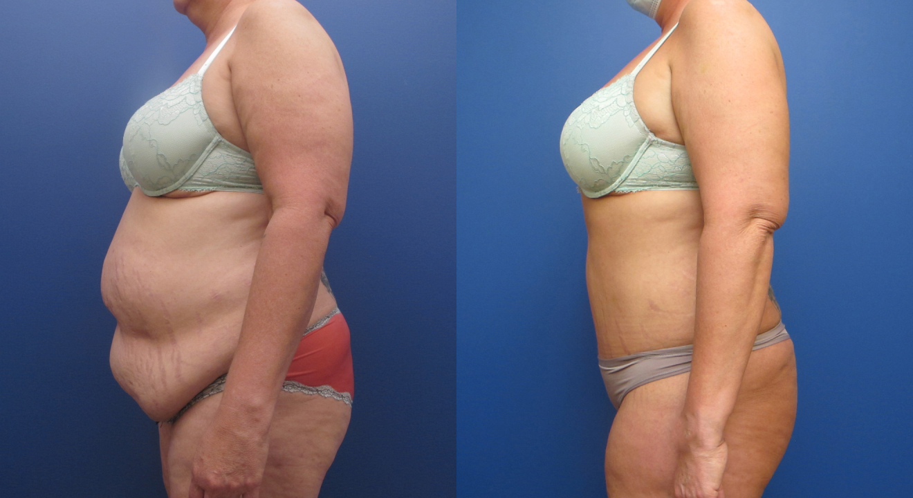 Clinic805-Victoria-Before-After-Abdominoplasty-2-2