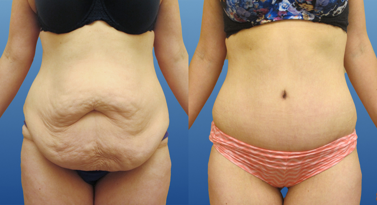 Clinic805-Victoria-Before-After-Abdominoplasty-3-1