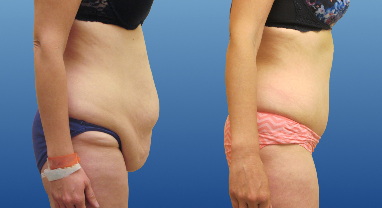 Clinic805-Victoria-Before-After-Abdominoplasty-3-2