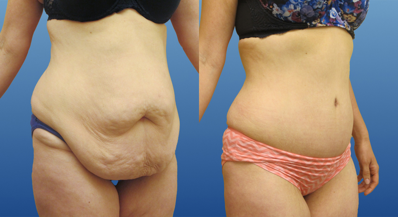 Clinic805-Victoria-Before-After-Abdominoplasty-3-3