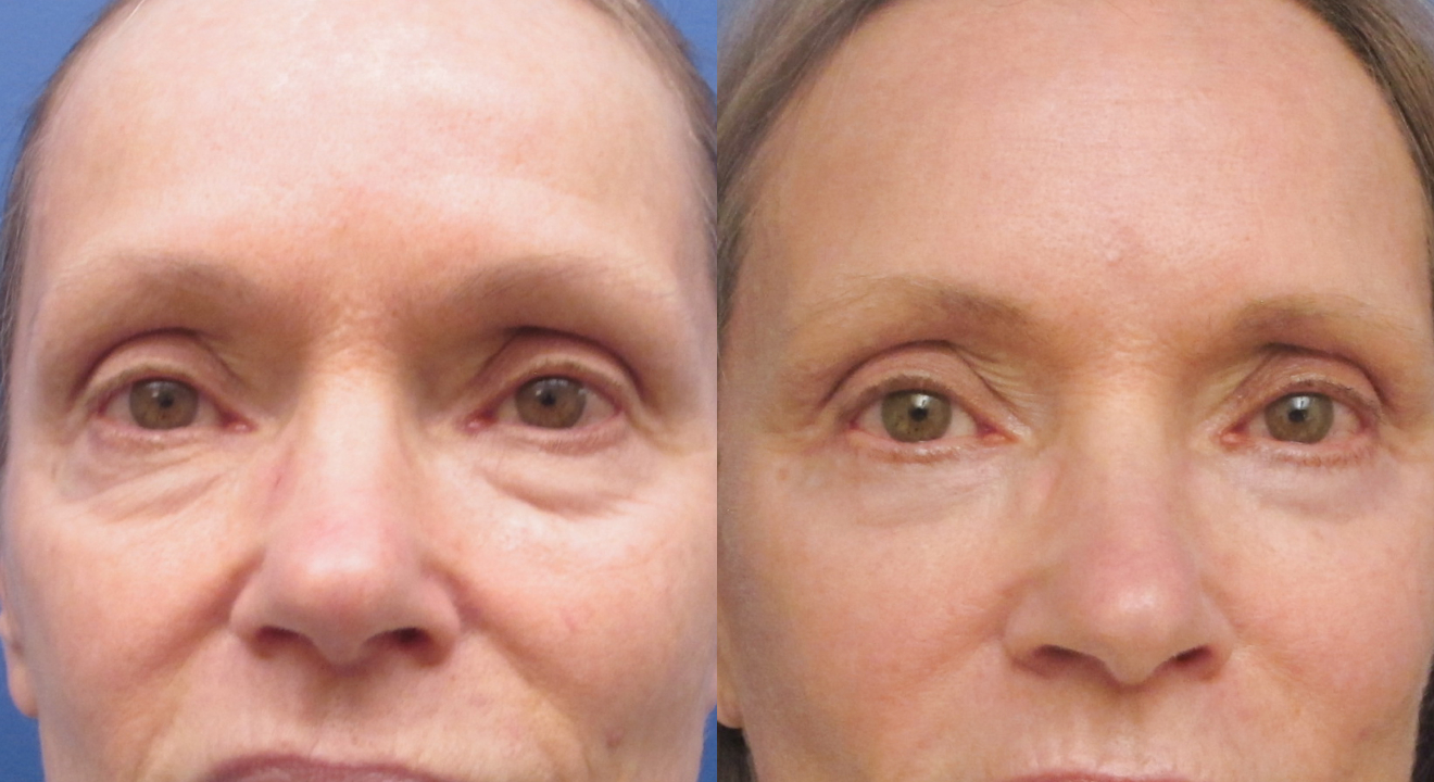 Clinic805-Victoria-Before-After-Blepharoplasty-1-1