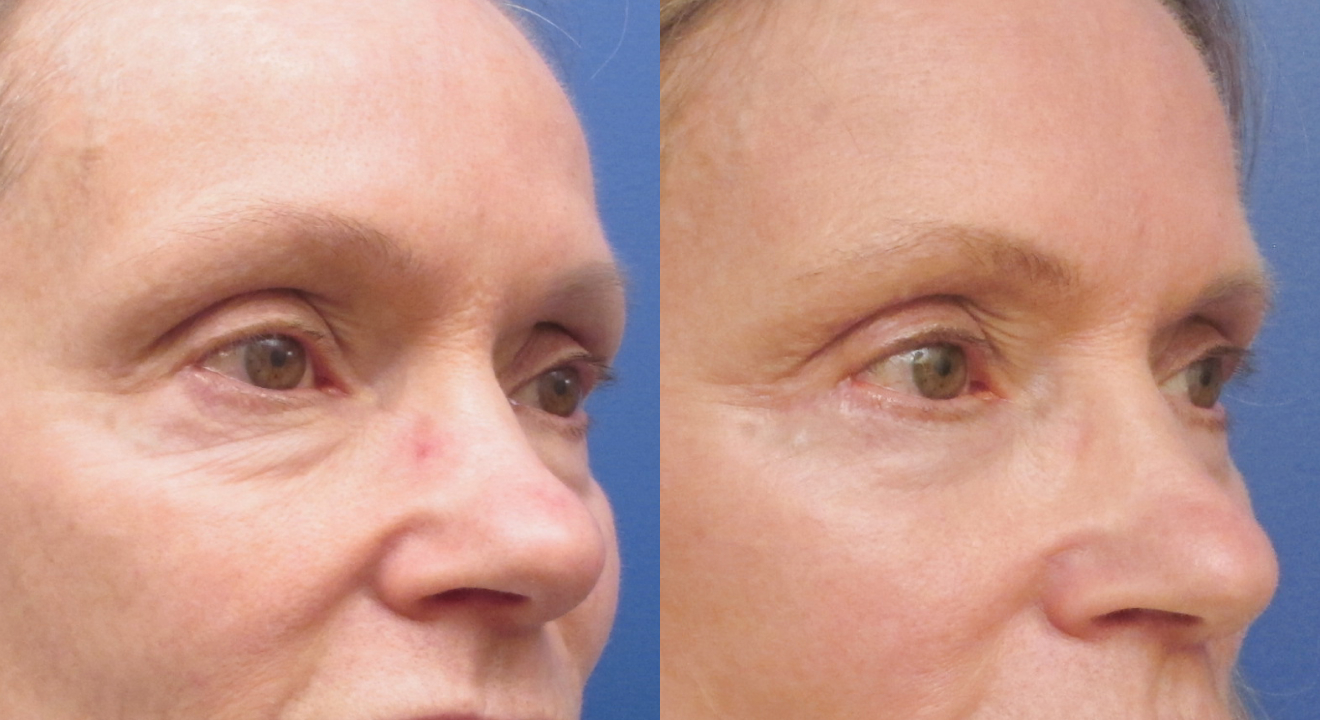 Clinic805-Victoria-Before-After-Blepharoplasty-1-2