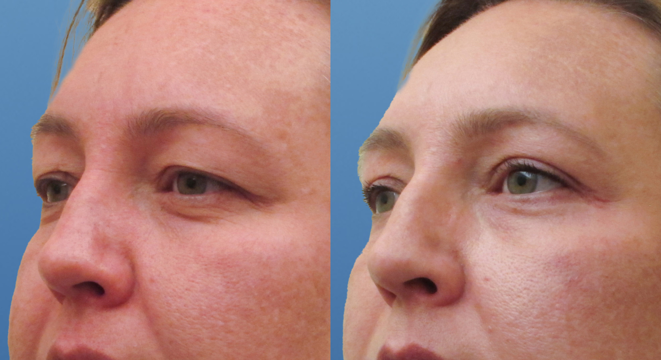 Clinic805-Victoria-Before-After-Blepharoplasty-2-1