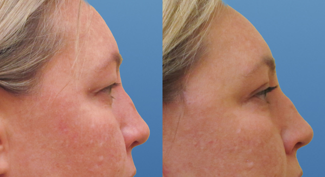 Clinic805-Victoria-Before-After-Blepharoplasty-2-2