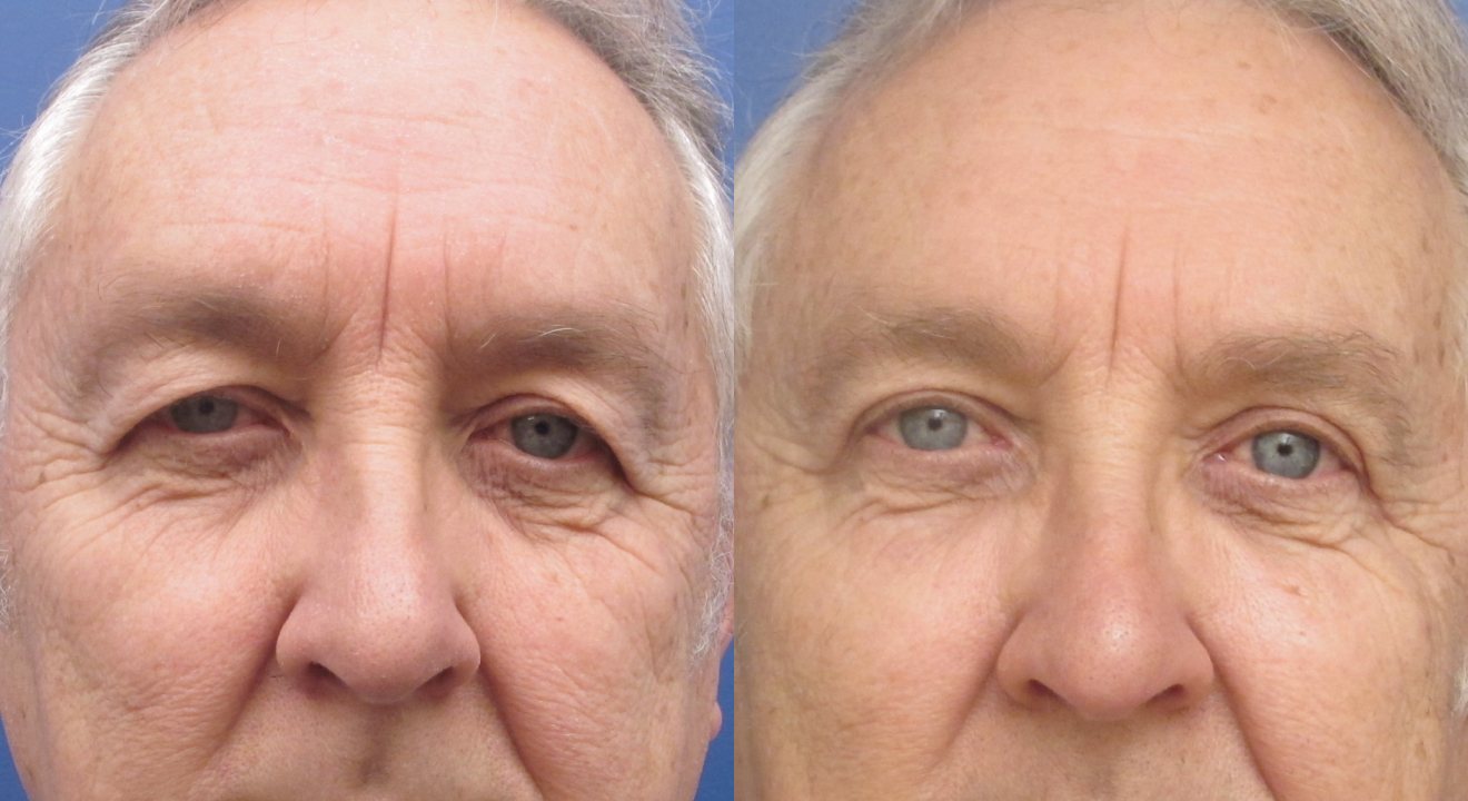 Clinic805-Victoria-Before-After-Blepharoplasty-3-1
