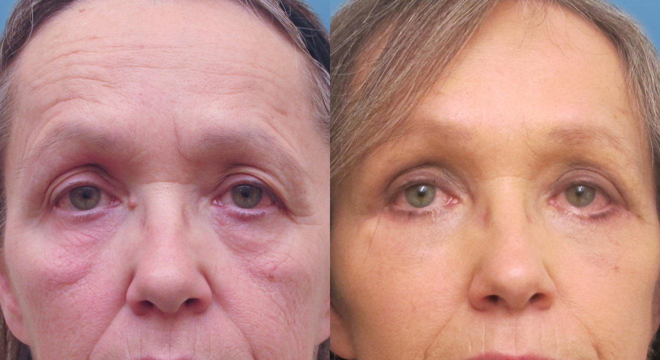Clinic805-Victoria-Before-After-Blepharoplasty-4-1