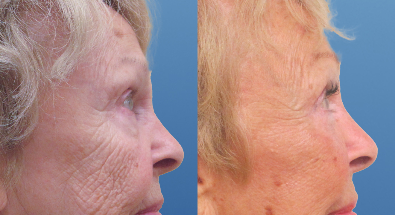 Clinic805-Victoria-Before-After-Blepharoplasty-5-2
