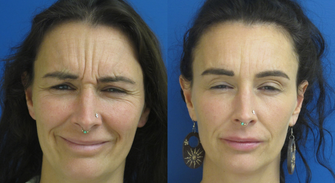 Clinic805-Victoria-Before-After-Botox-1-2