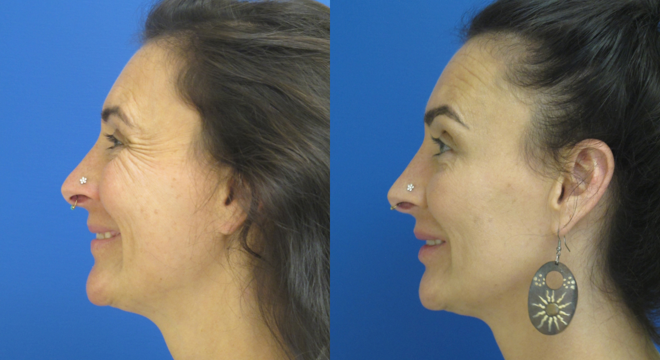 Clinic805-Victoria-Before-After-Botox-1-4