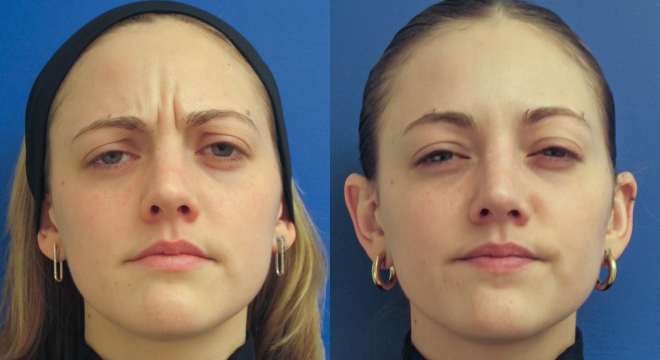Clinic805-Victoria-Before-After-Botox-2-1