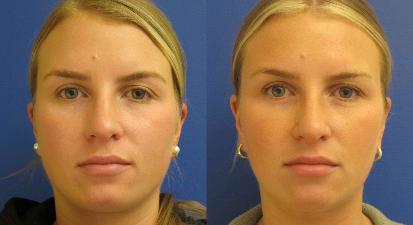 Clinic805-Victoria-Before-After-Botox-3-1