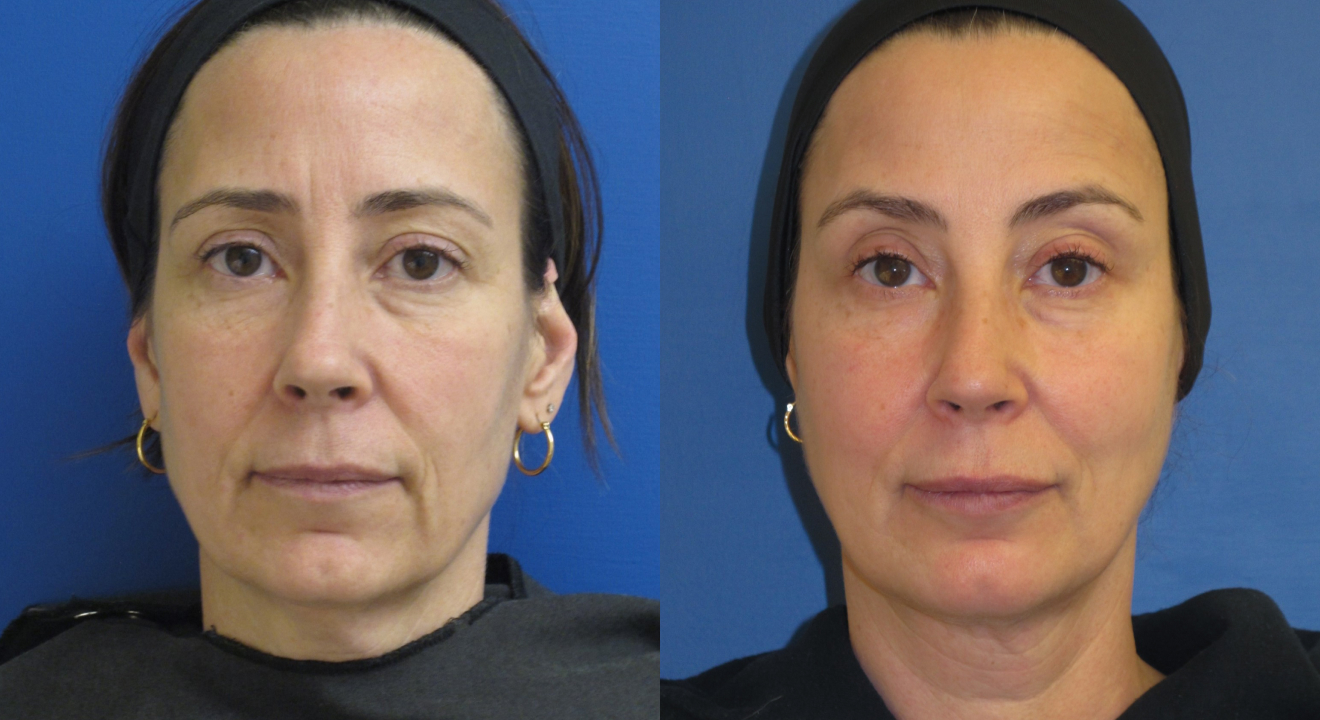 Clinic805-Victoria-Before-After-Botox-Filler-1-1