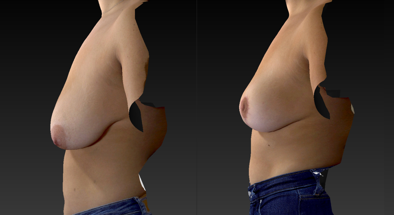 Clinic805-Victoria-Before-After-Breast-Lift-1-2
