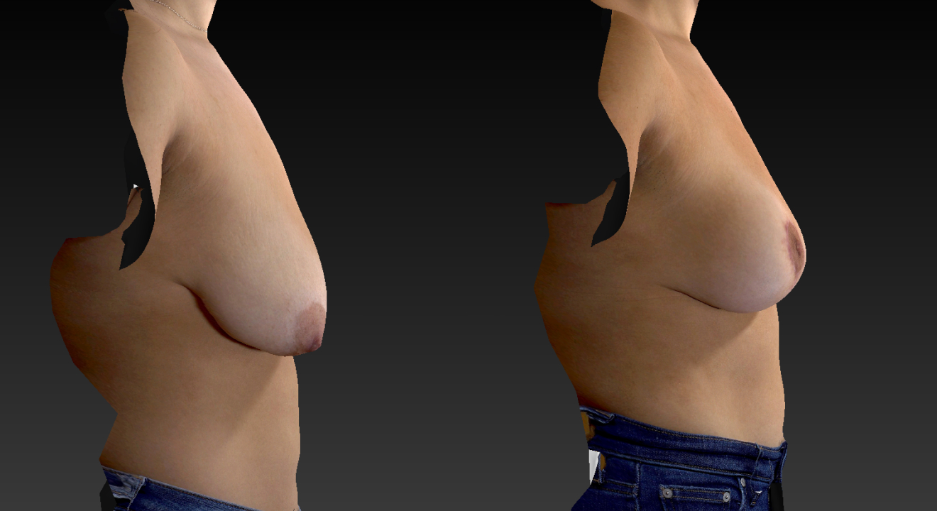Clinic805-Victoria-Before-After-Breast-Lift-1-3