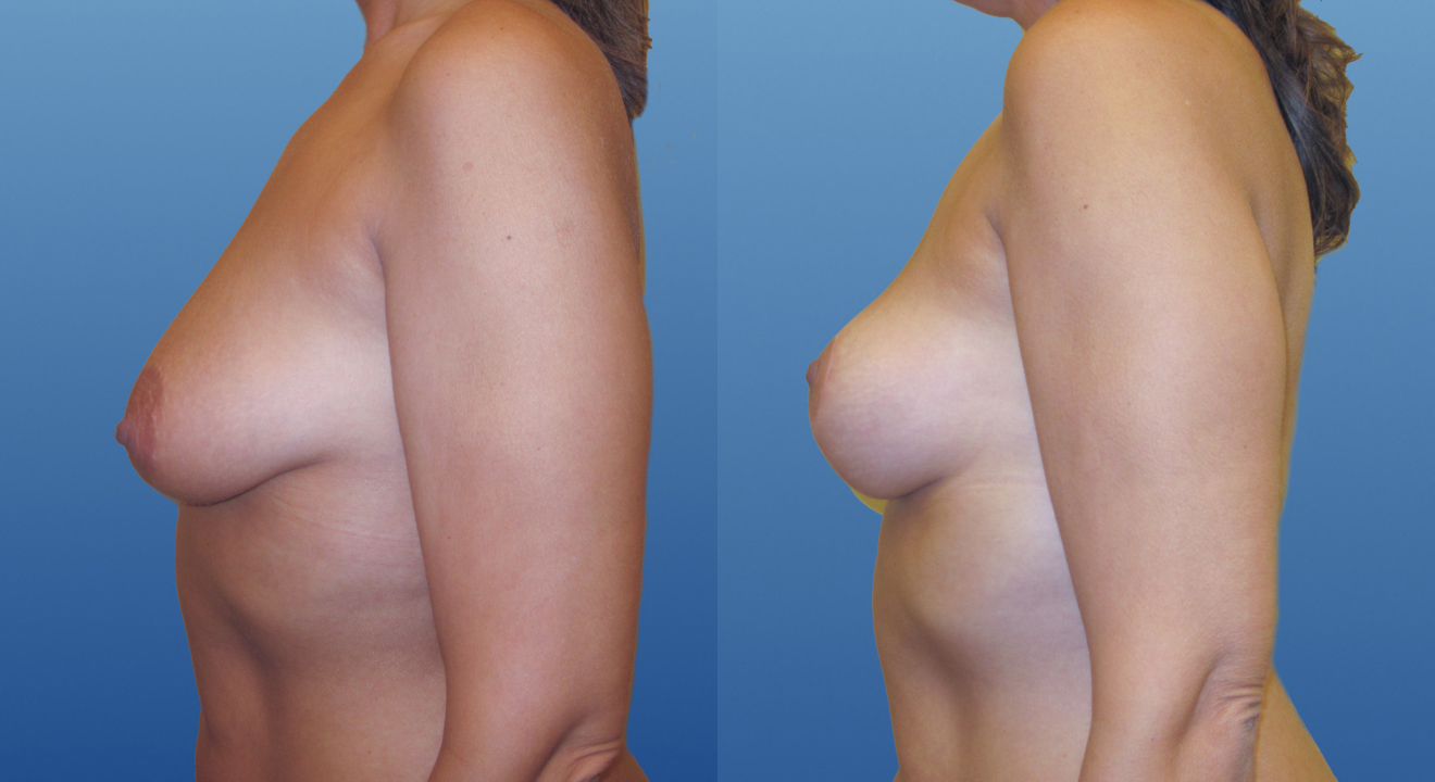 Clinic805-Victoria-Before-After-Breast-Lift-2-2