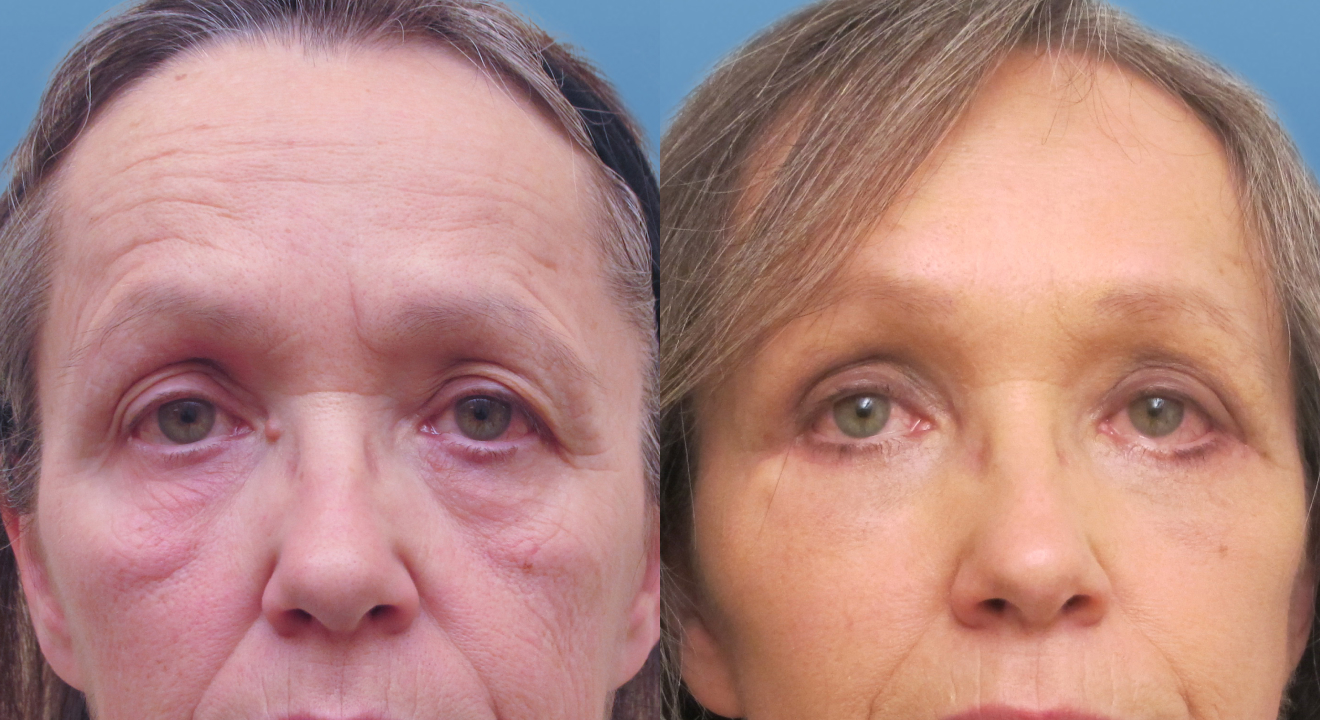 Clinic805-Victoria-Before-After-Brow-Lift-1-1