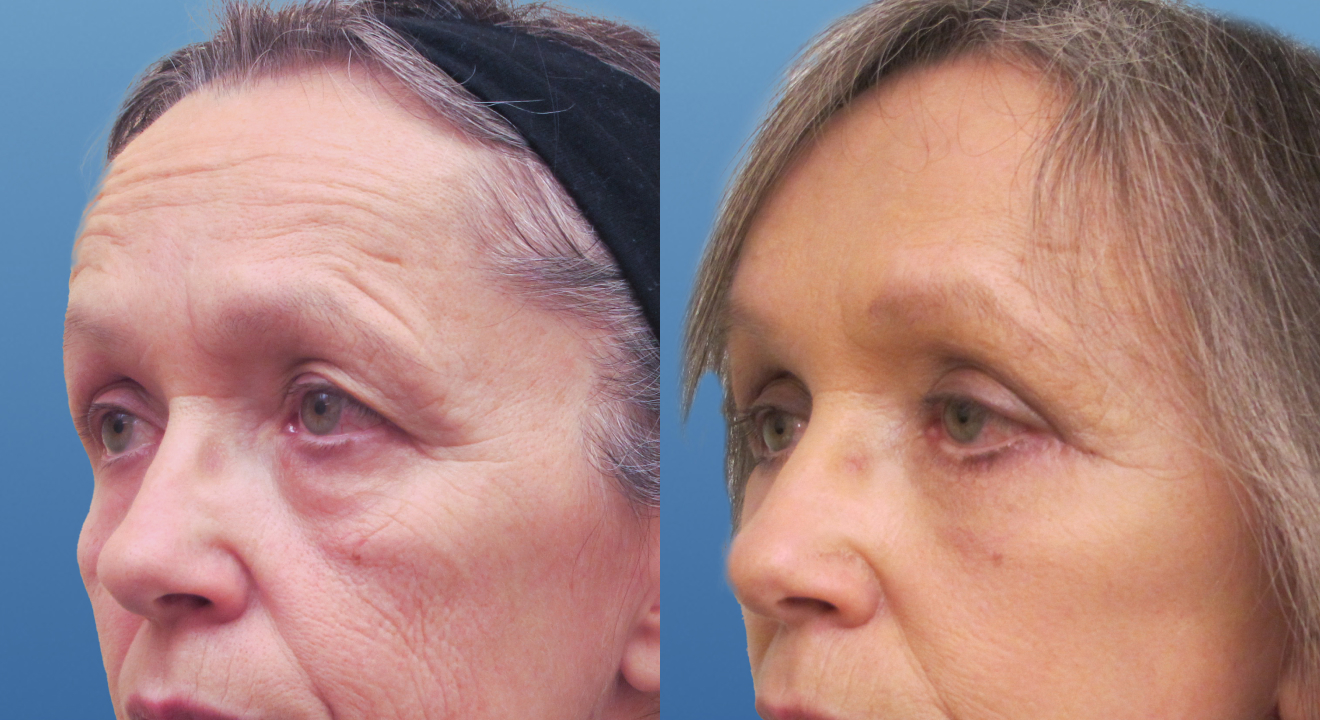 Clinic805-Victoria-Before-After-Brow-Lift-1-2