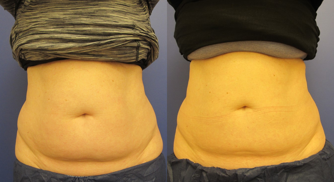 Clinic805-Victoria-Before-After-CoolSculpting-1-1