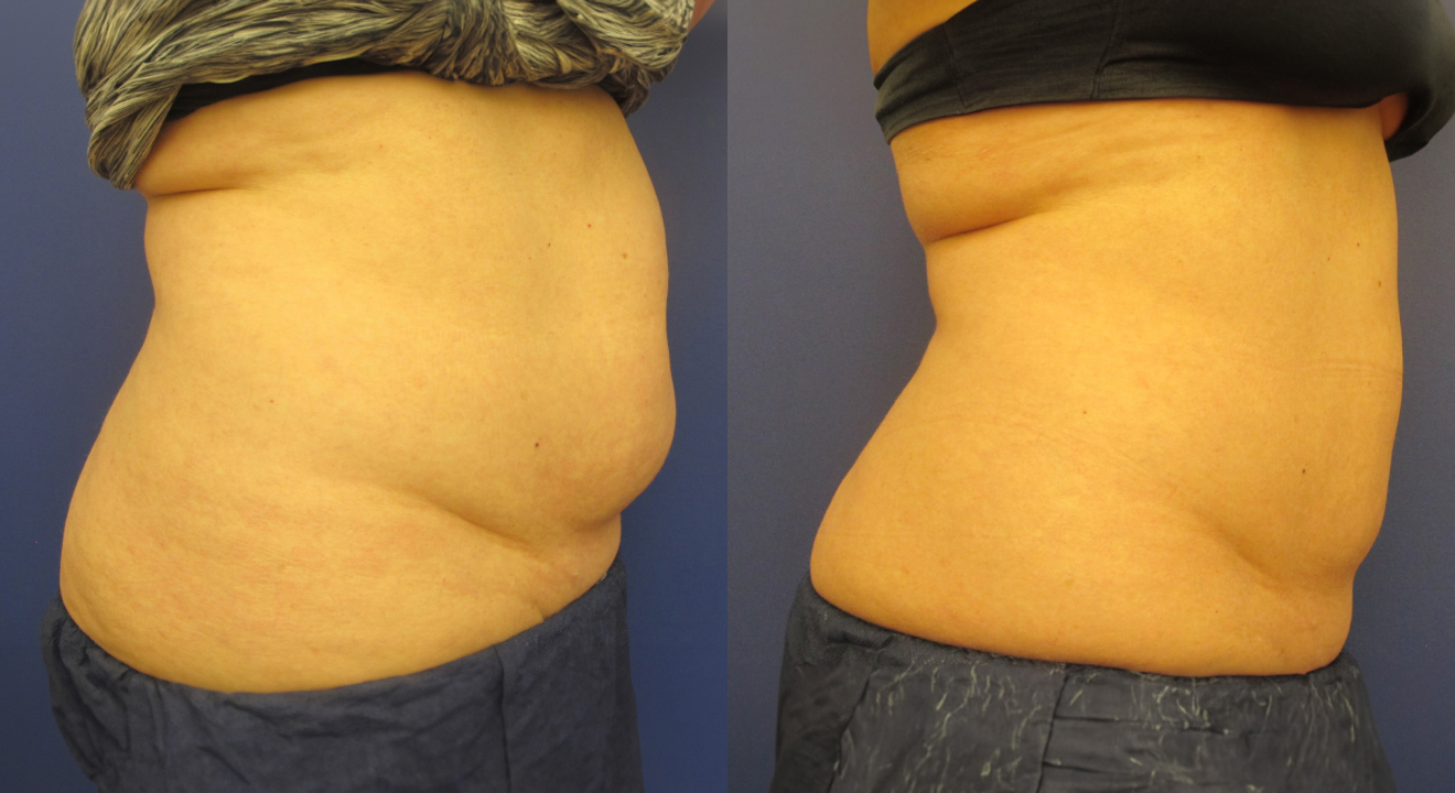 Clinic805-Victoria-Before-After-CoolSculpting-1-2