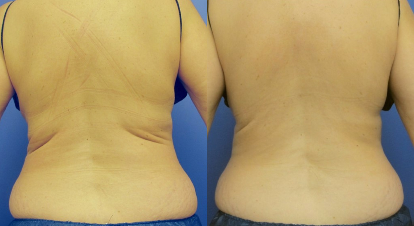 Clinic805-Victoria-Before-After-CoolSculpting-2-1