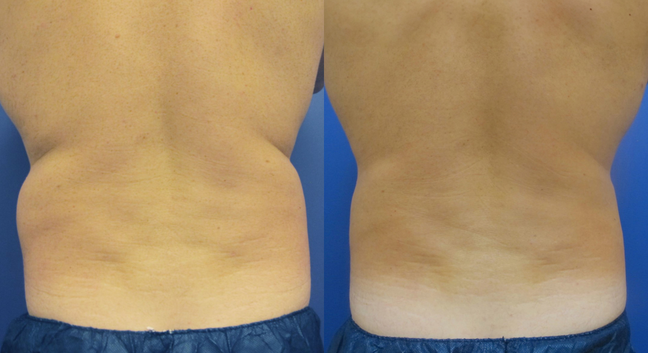 Clinic805-Victoria-Before-After-CoolSculpting-3-1