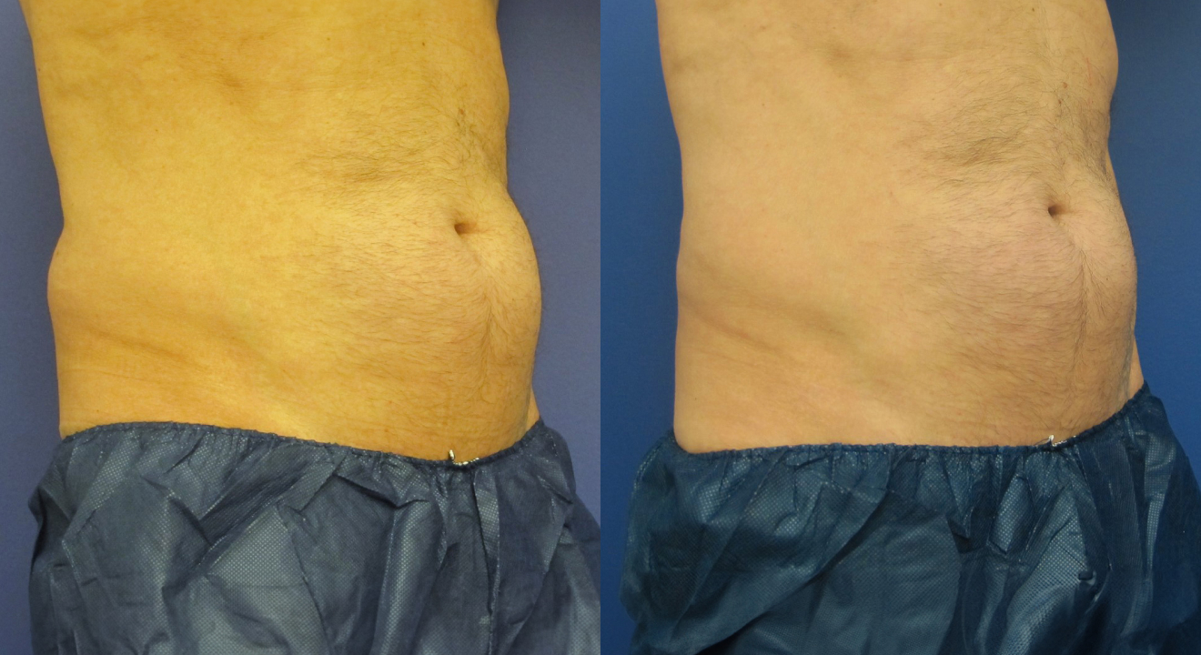 Clinic805-Victoria-Before-After-CoolSculpting-4-1