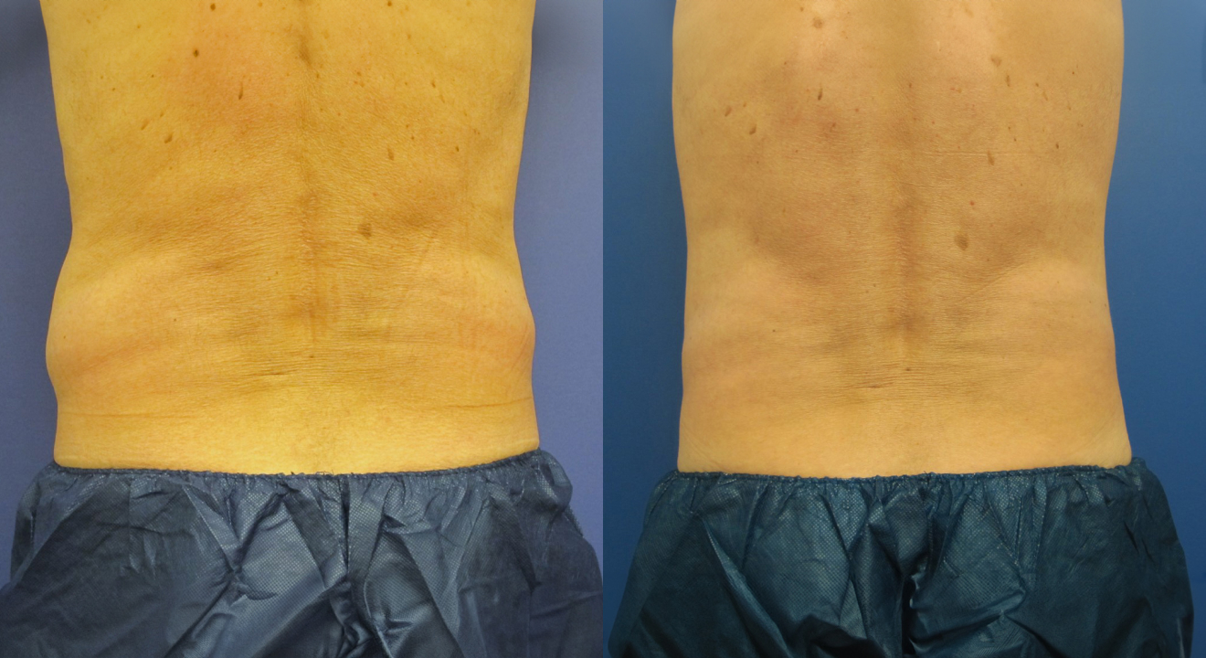 Clinic805-Victoria-Before-After-CoolSculpting-4-2