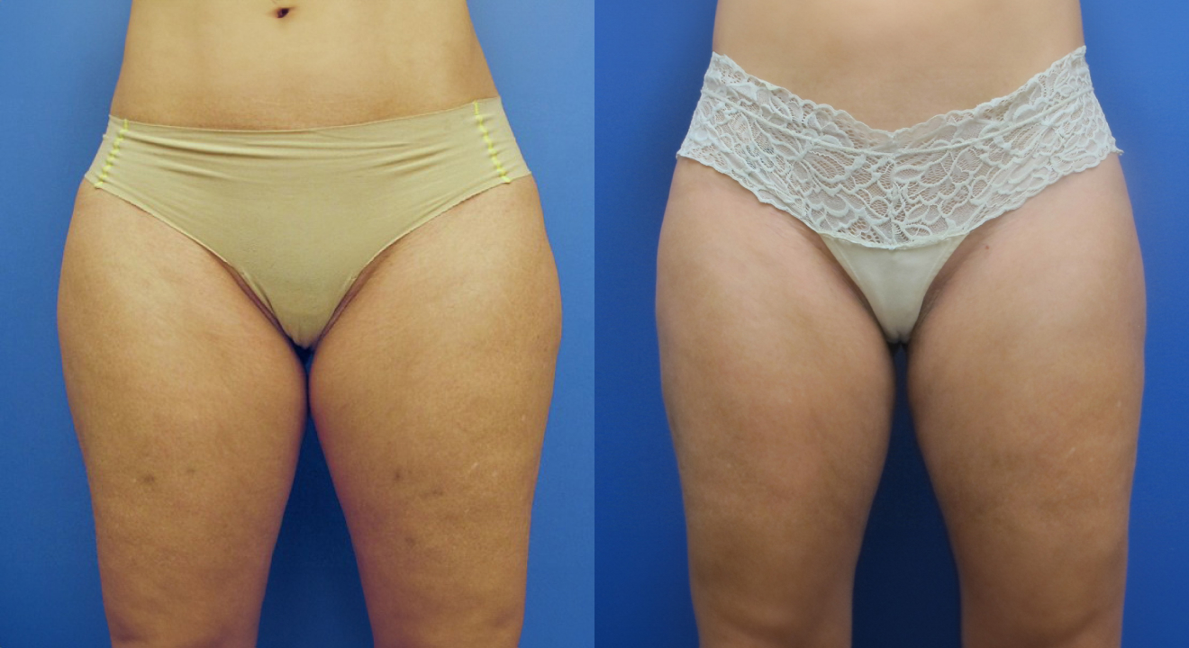 Clinic805-Victoria-Before-After-CoolSculpting-5-1