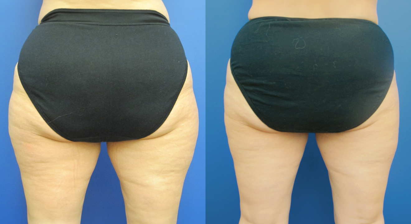 Clinic805-Victoria-Before-After-CoolSculpting-6-1