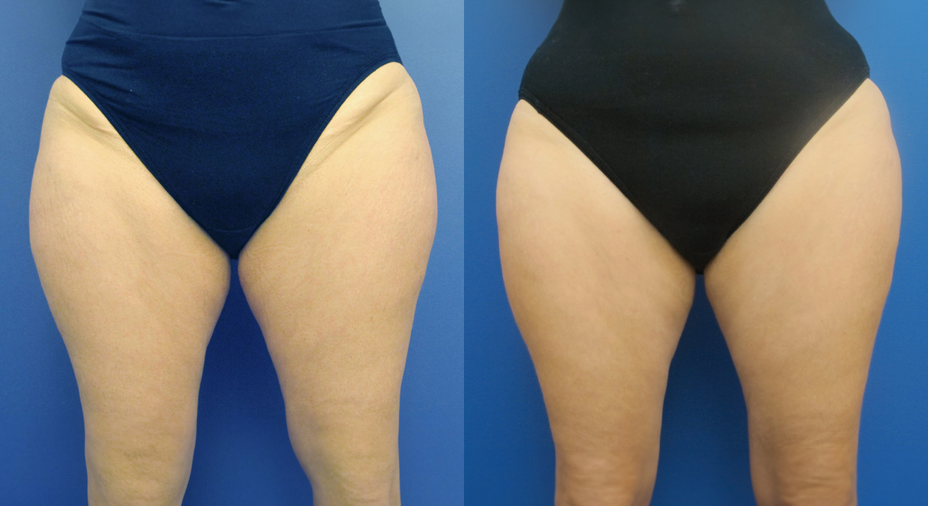 Clinic805-Victoria-Before-After-CoolSculpting-6-2