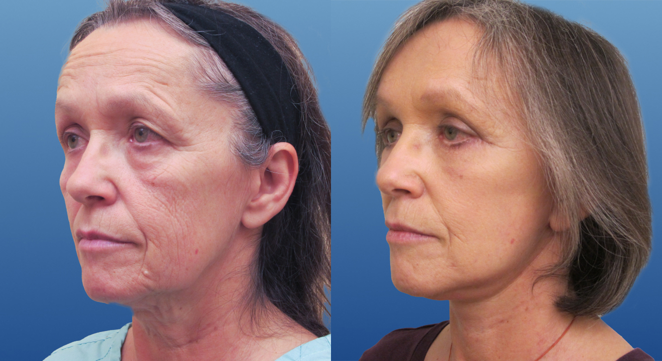 Clinic805-Victoria-Before-After-Face-Lift-3-2