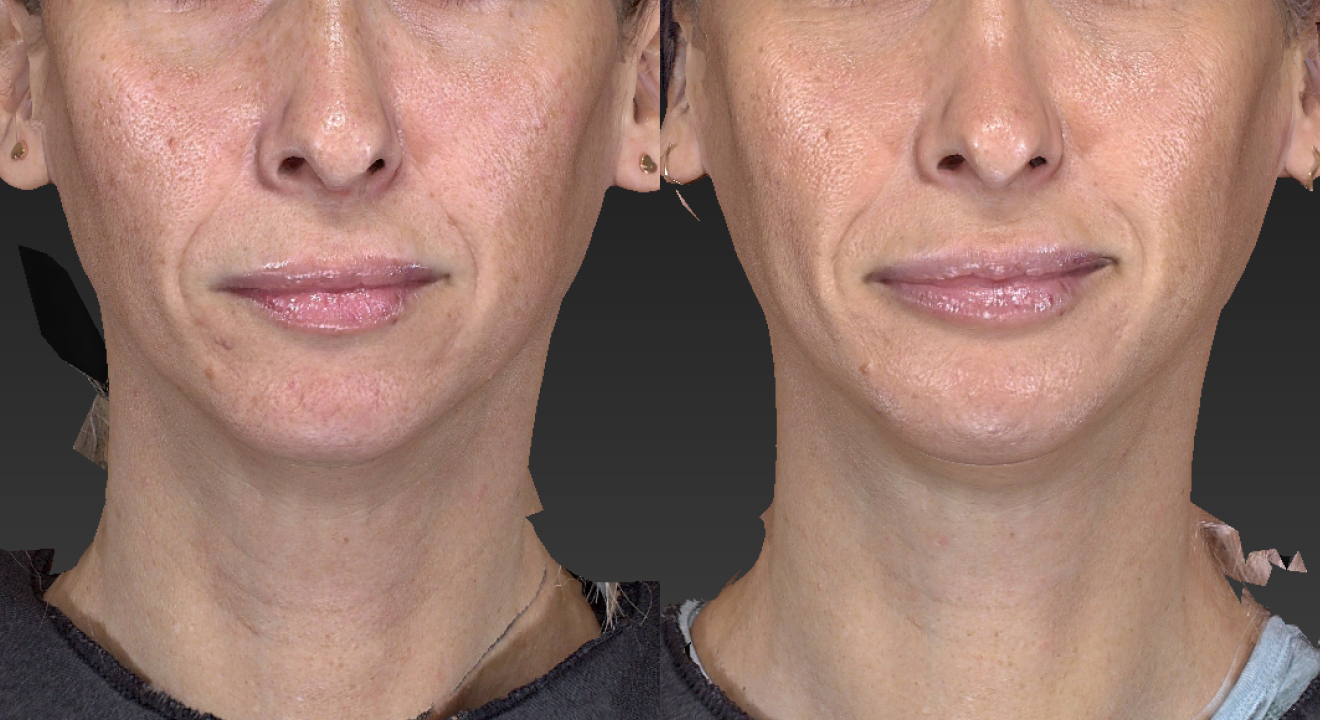 Clinic805-Victoria-Before-After-Genioplasty-1-1