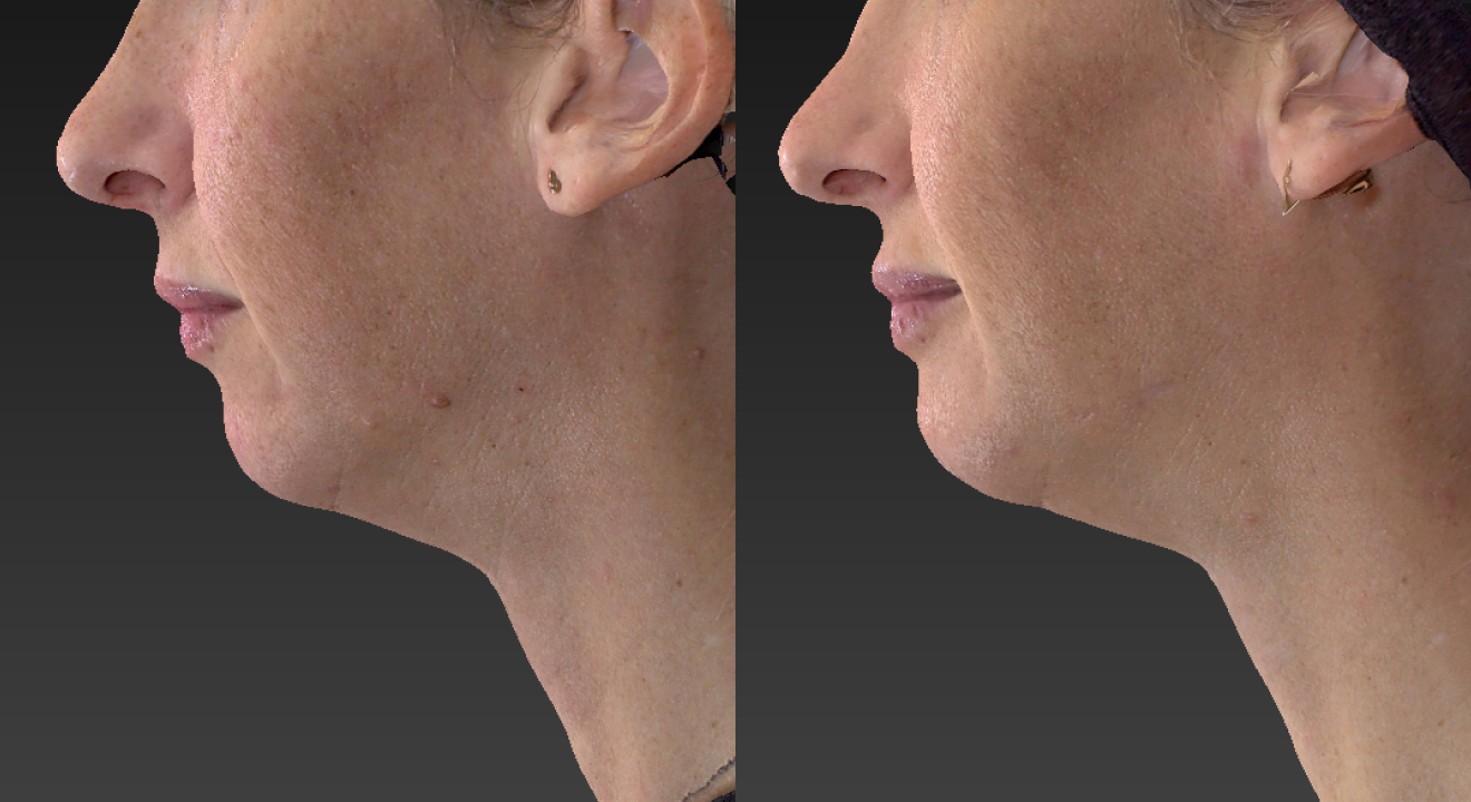 Clinic805-Victoria-Before-After-Genioplasty-1-2