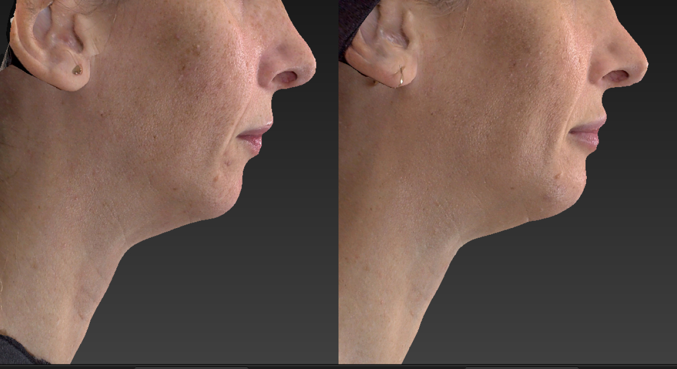 Clinic805-Victoria-Before-After-Genioplasty-1-3