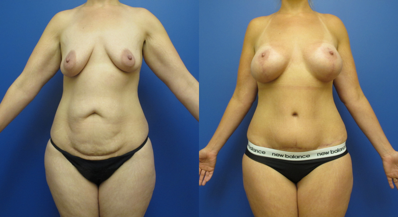 Clinic805-Victoria-Before-After-Mommy-Makeover-1-1