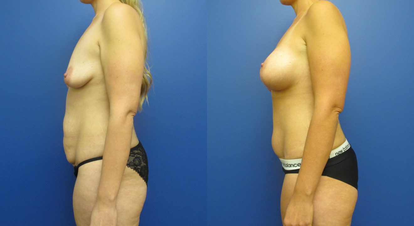 Clinic805-Victoria-Before-After-Mommy-Makeover-1-2