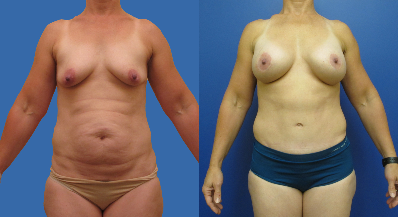 Clinic805-Victoria-Before-After-Mommy-Makeover-2-1