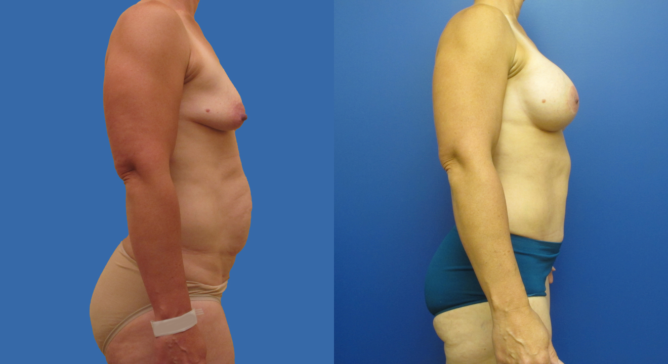 Clinic805-Victoria-Before-After-Mommy-Makeover-2-2