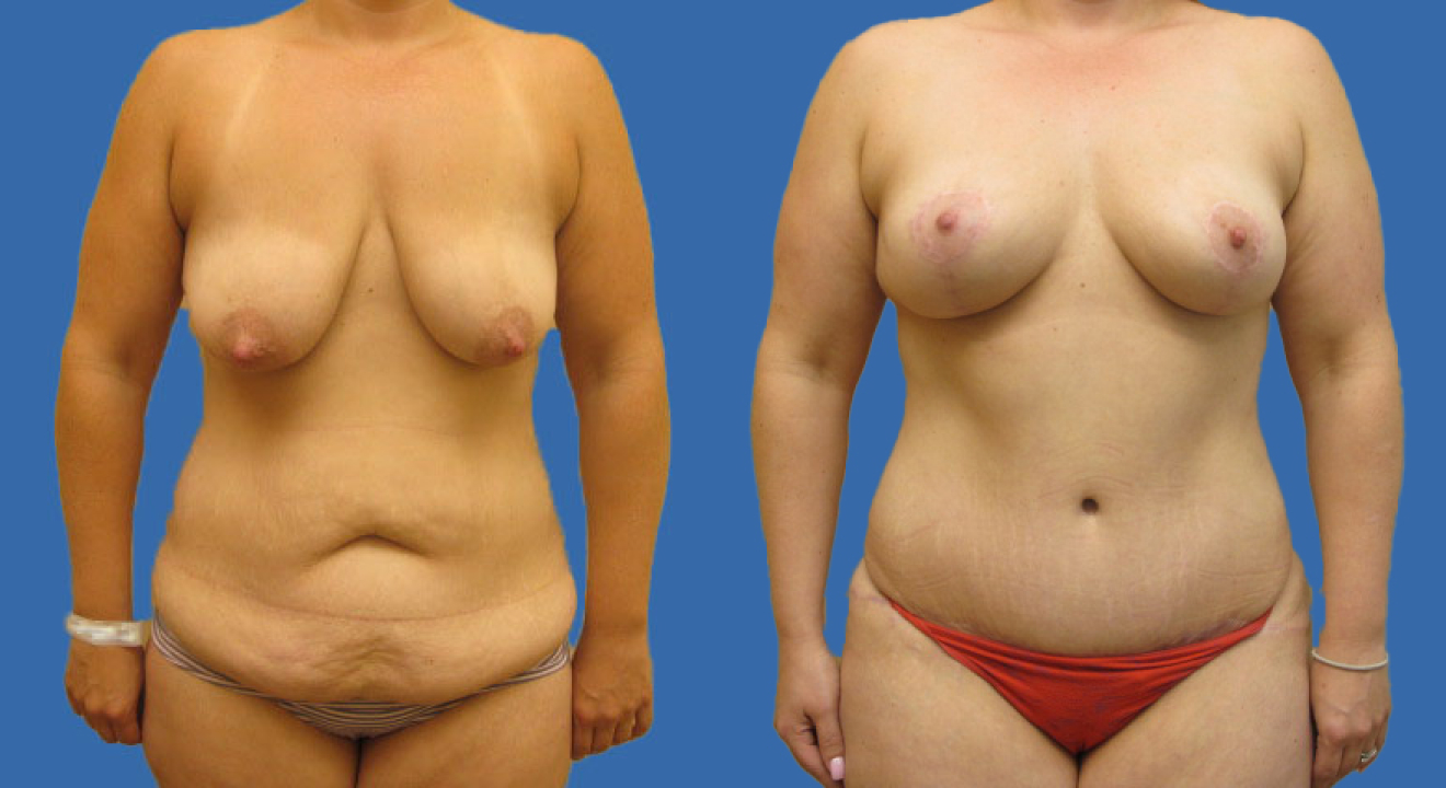 Clinic805-Victoria-Before-After-Mommy-Makeover-3-1