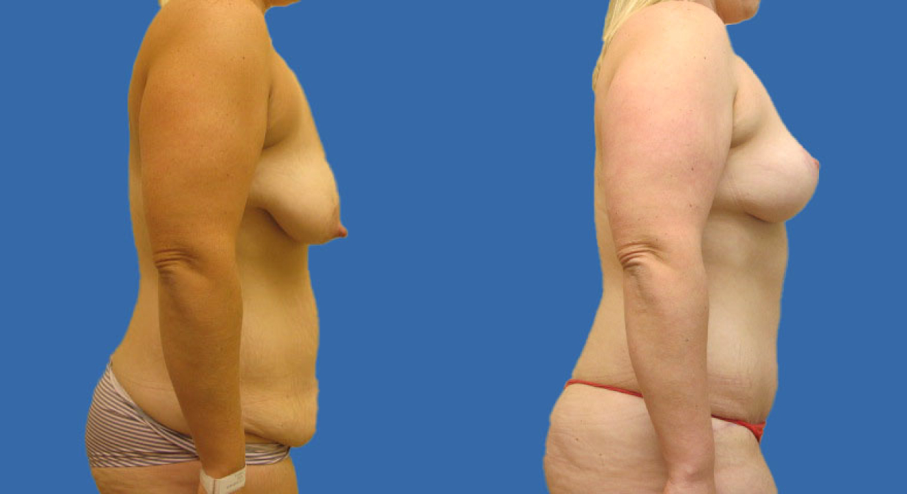 Clinic805-Victoria-Before-After-Mommy-Makeover-3-2