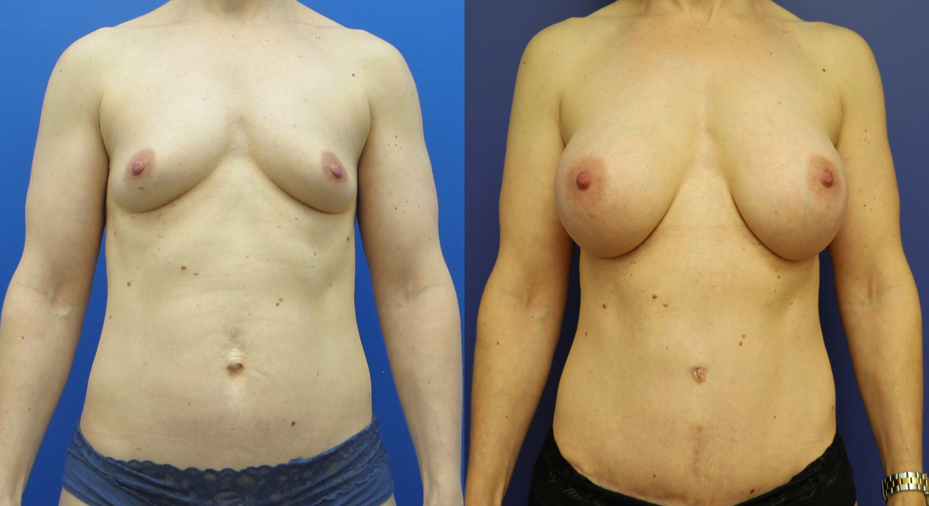 592007729-clinic805-victoria-before-after-mommy-makeover-4-1