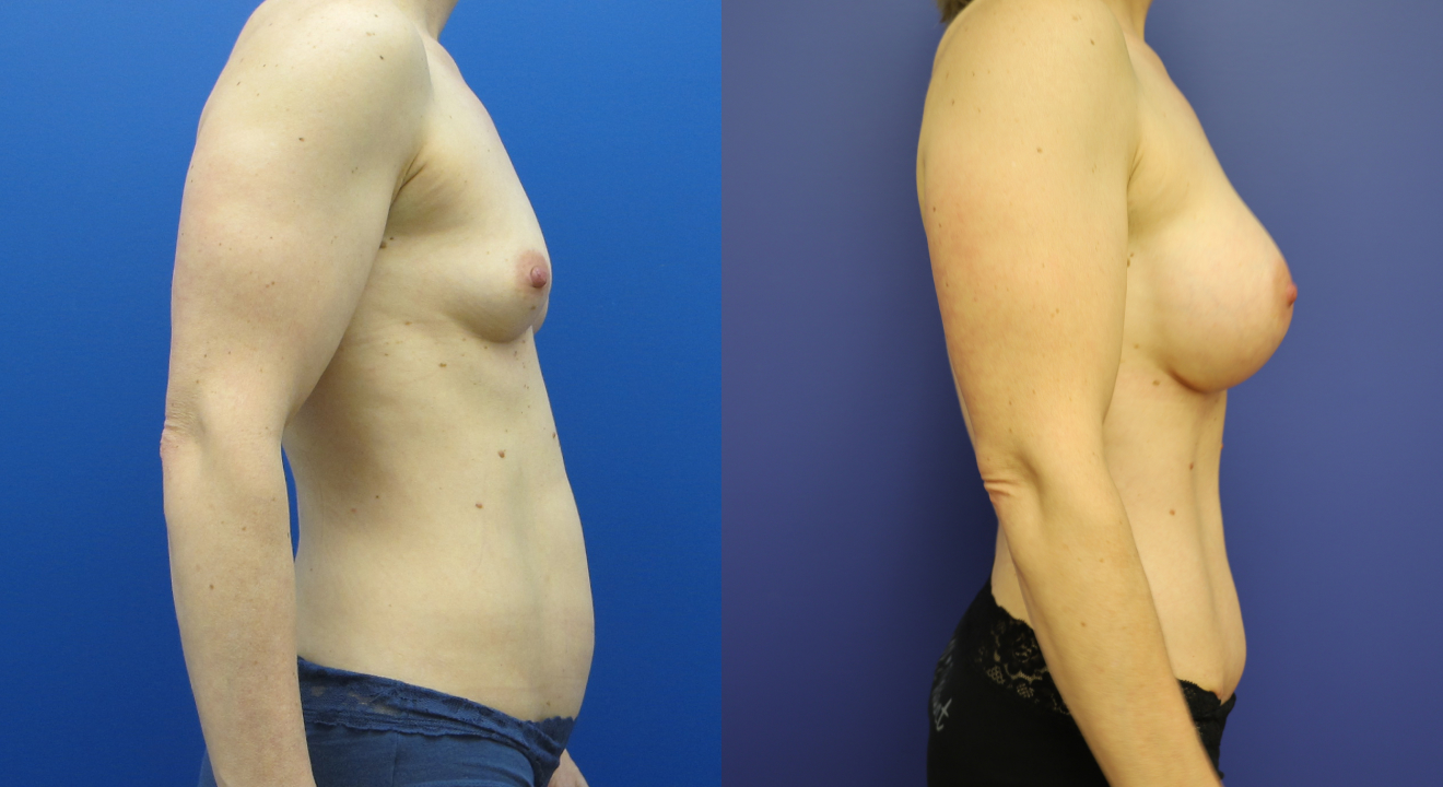 592007740-clinic805-victoria-before-after-mommy-makeover-4-2