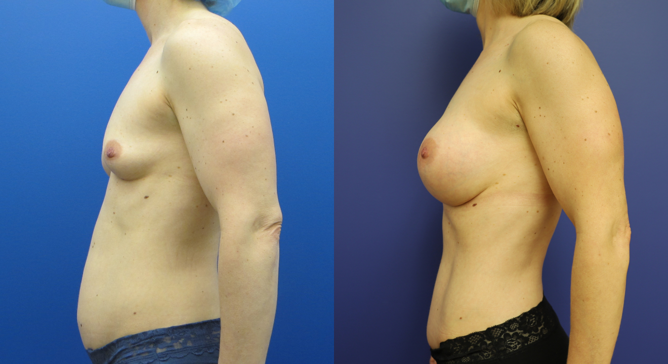 592007740-clinic805-victoria-before-after-mommy-makeover-4-2
